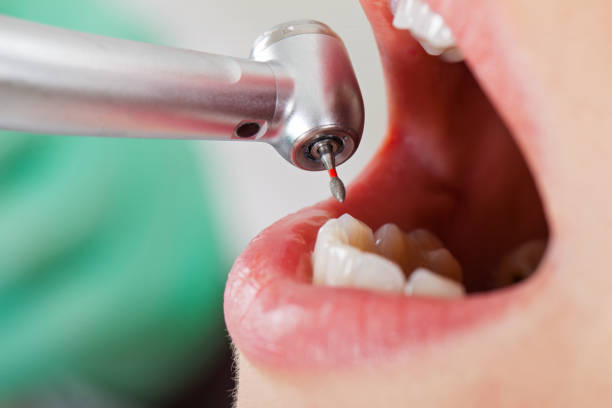 Best Lost Filling or Crown Replacement in Ocala, FL